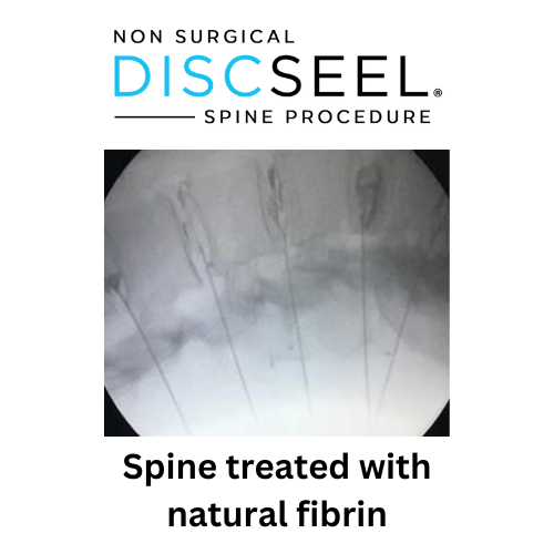 Spine Treated with microscopic needles (2)